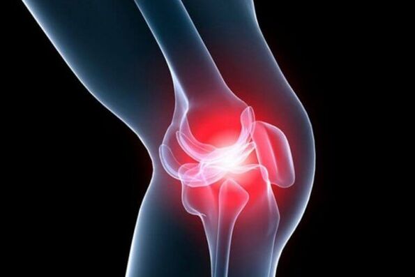 Остеоартроз коленного сустава
