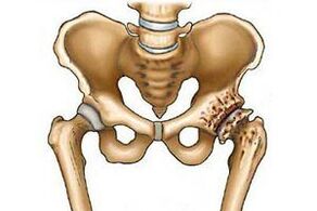 Разрушение тазобедренного сустава при остеоартрозе