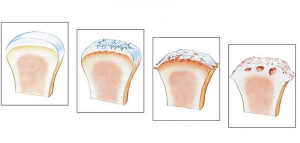 Здоровый голеностопный сустав и степень развития остеоартроза